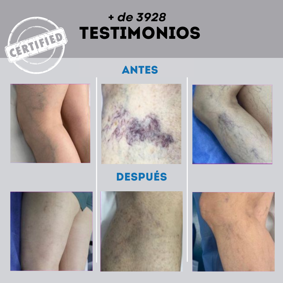 🌿Varicose Spray ✨Elimina Varices Rápido y Sin Dolor😍