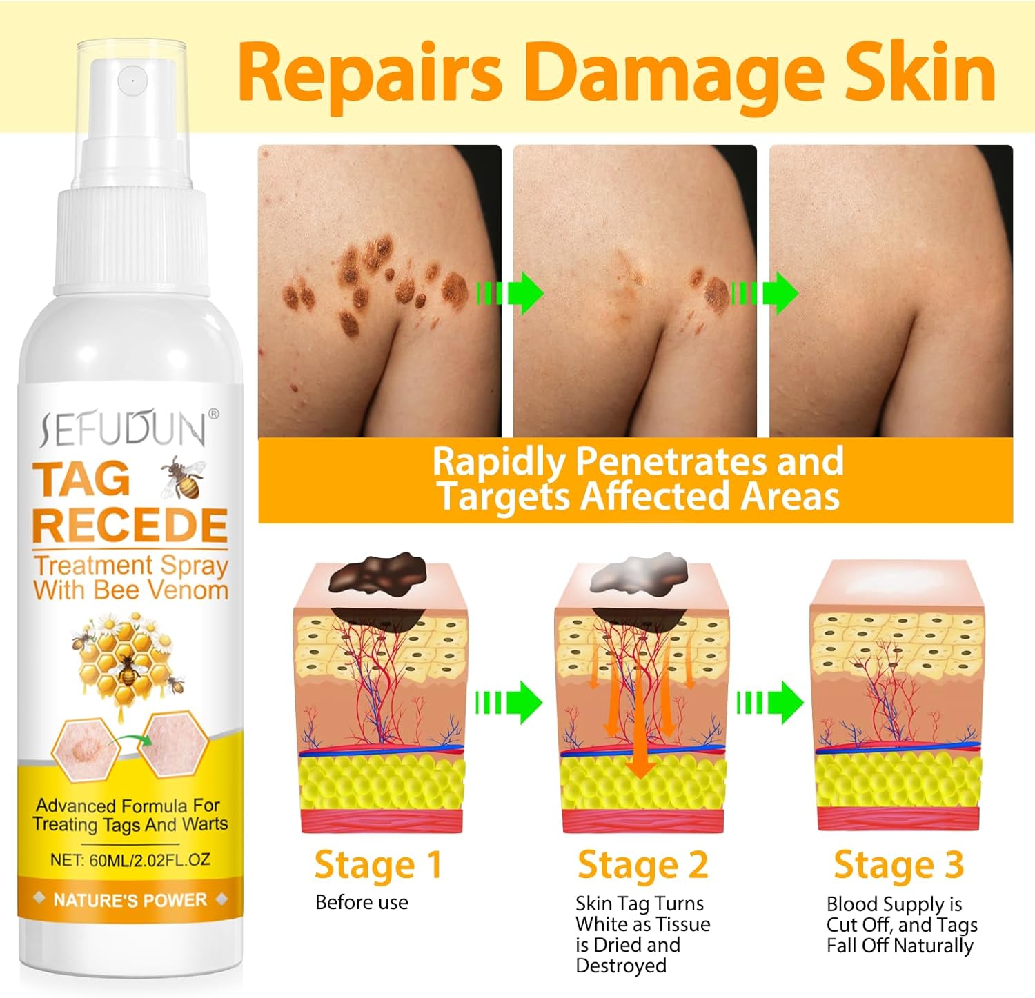 ✨TagRecede Tratamiento Para la Eliminación de Verrugas🌿